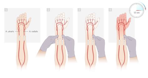 TOPIC 5 Hemodynamic Monitoring Arterial Line Central Line Invasive