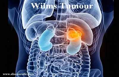 Wilms Tumor Causes Diagnosis And Complications