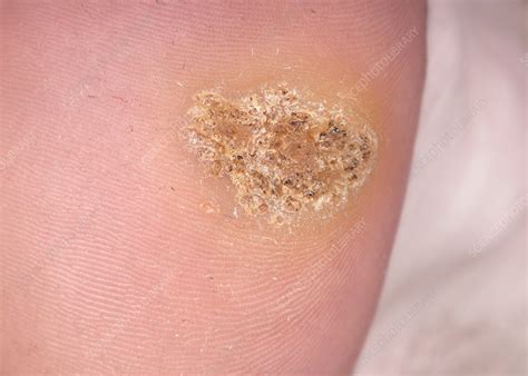 Common warts - Stock Image - C037/1209 - Science Photo Library