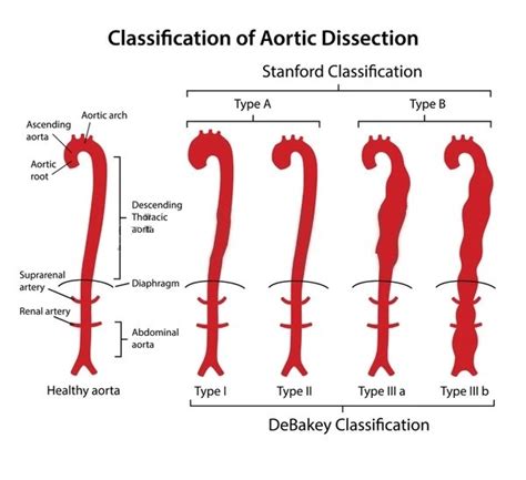 Aortic Dissection Aortic Dissection Nursing Map Location Map Maps The