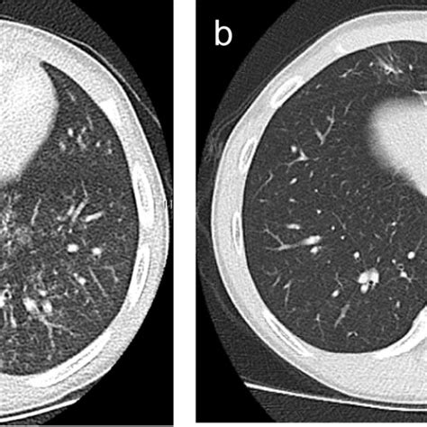 Cross Sectional Images Of High Resolution Ct Chest Demonstrating