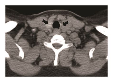 Preoperative CT scan of the neck. The preoperative CT scan of the neck... | Download Scientific ...