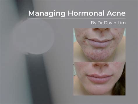 Hormonal Acne Explained In 3 Minutes By Dermatologist