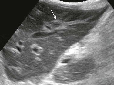 Periportal edema in a 12-year-old boy with viral hepatitis. A longitudinal sonogram demonstrates ...