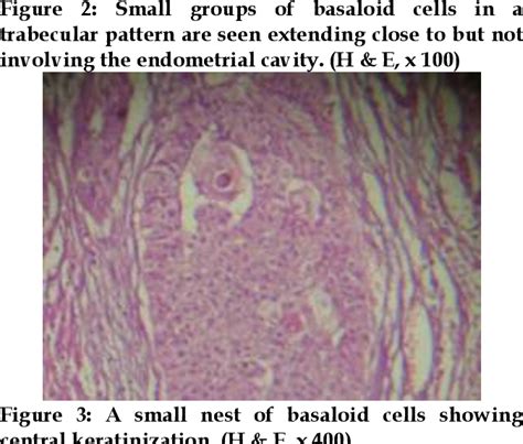 Figure 3 From Basaloid Squamous Cell Carcinoma Of The Uterine Cervix