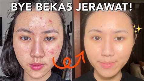 Cara Menghilangkan Bekas Jerawat Pih Tanpa Skincare Bye Bekas