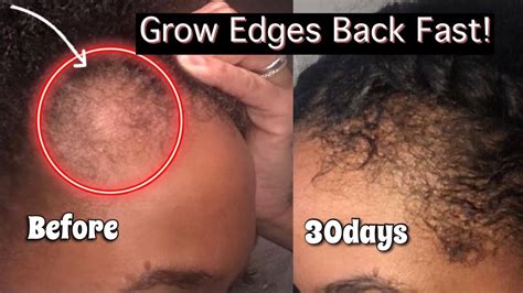 How To Regrow Edges On Natural Hair Fast And Easytips For Hair Loss