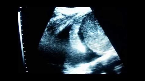 Ultrasound diagnosis of hemothorax - YouTube