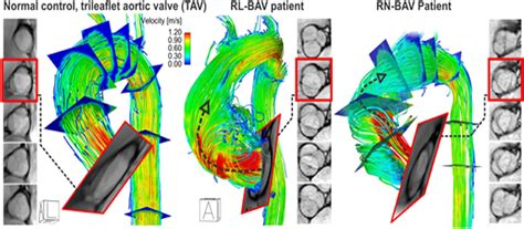 Frontiers Evolution Of Precision Medicine And Surgical Strategies For Bicuspid Aortic Valve