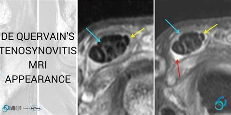 De Quervain S Synovitis