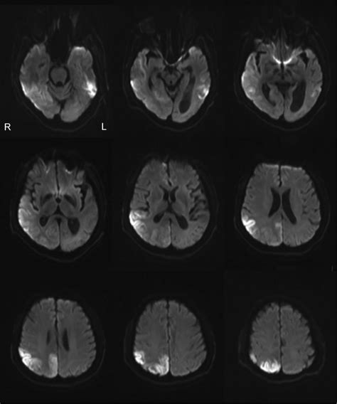 Diffusion Weighted Image Dwi The Cytotoxic Edema The Regions With