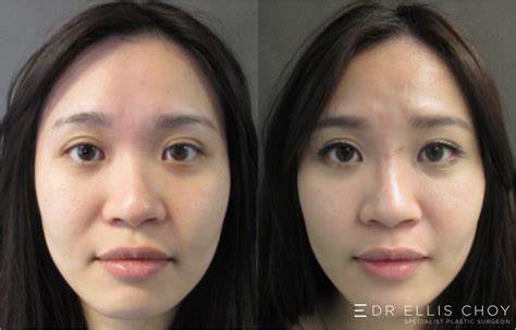 Asian Rhinoplasty Before And After