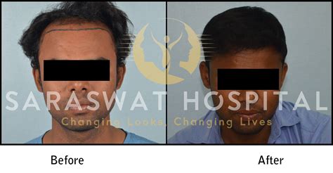 Hair Transplantation Before And After Results Saraswat Hospital