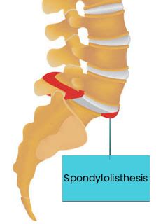 Spondylolisthesis | Causes & Symptoms | Top Spine Surgeon | Ashish Sahai