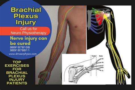 What Is Brachial Plexus Archives Dr Nasirphysiotherapy And Rehabilation