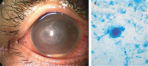 Eye Infection Patient Goes Blind By Med Mal Reviewer