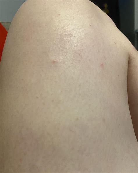 Does this look like Scabies : r/scabies