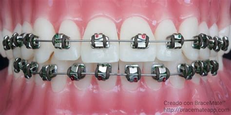 12 Ideas De Colores Para Brackets Para Destacar Somos Dental