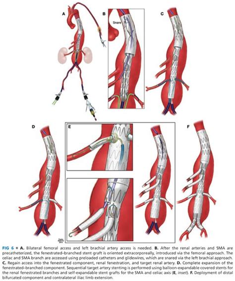 Branched and Fenestrated Endovascular Stent Graft Techniques | Thoracic Key