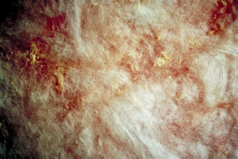 The Dangers Of Sanding Fiberglass Resin Hunker Treat Psoriasis