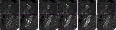 Time Resolved Dynamic Computed Tomography Angiography For Characterization Of Aortic Endoleaks