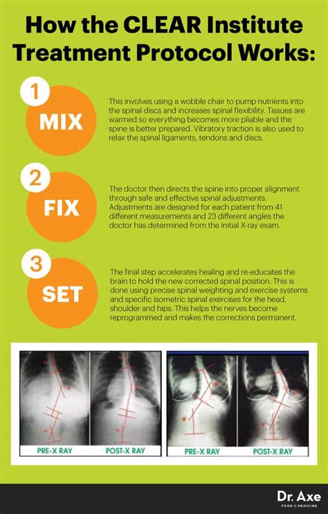 Scoliosis Exercises And Natural Treatment Plan