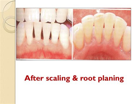 Principles Of Scaling And Root Planing Dr Alaa Attia