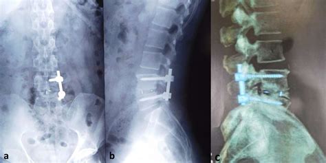 Transforaminal Lumbar Interbody Fusion Tlif Total Spine 60 Off