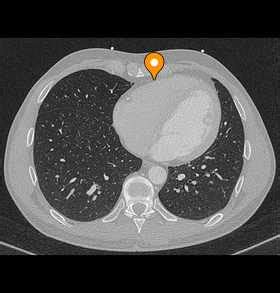 Epicardium - e-Anatomy - IMAIOS