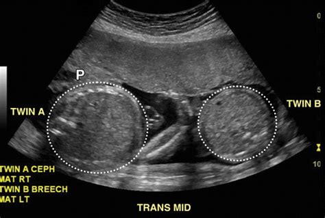 Identical Twins Ultrasound 20 Weeks