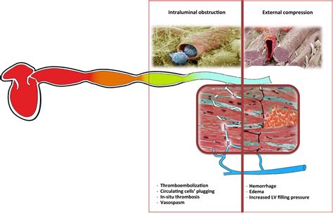 Coronary Microvascular Injury In Reperfused Acute Myocardial Infarction