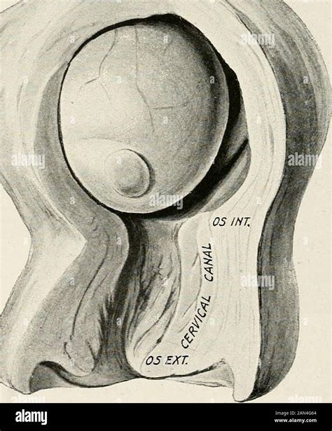 Ginecología Para Estudiantes Y Profesionales Fig 213 Tumor Fibroide