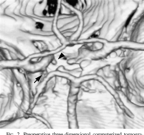 [pdf] Endoscope Assisted Clipping Of A Superior Hypophyseal Artery