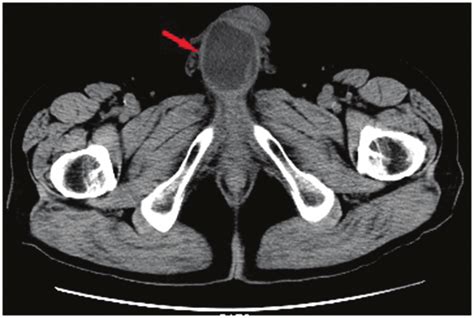 ct scan   mass    cm    cavernous body