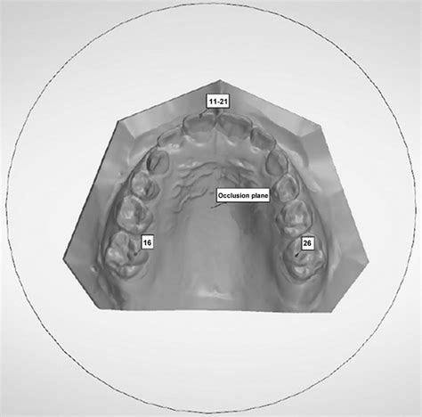 Occlusal View Of An Upper Dental Cast With The Occlusal Plane