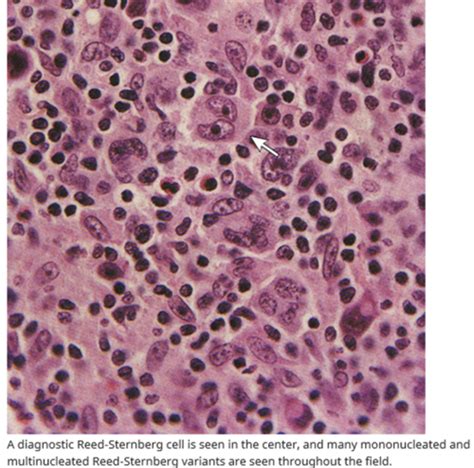 Liquid And Solid Tumors Flashcards Quizlet