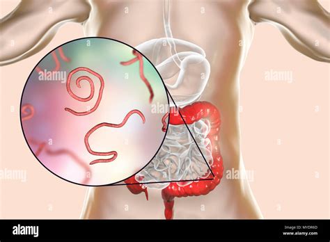 Pin Worms In Humans