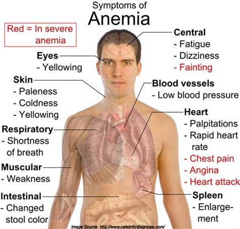 Is There A Link Between Iron Deficiency Anemia And Osteoarthritis