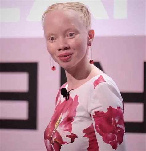 10 Most Famous Albino People - Discover Walks Blog