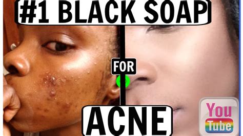 The 1 Best Black Soap For Acne Before And After Fair Rah♡ Youtube