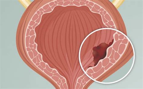 Cánceres urológicos y síndrome metabólico cuál es su relación Dr