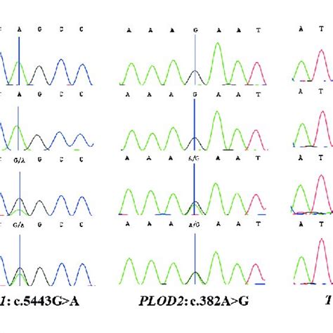 Dna Sequence Chromatograms Showing The Variants In The Fbn1 Plod2