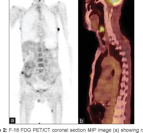 Figure From Fdg Pet Ct In A Rare Case Of Multiple Cutaneous