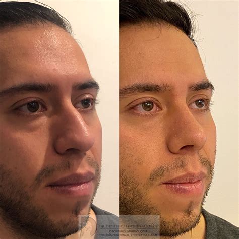 Pin On Rinoplastia Antes Y Después