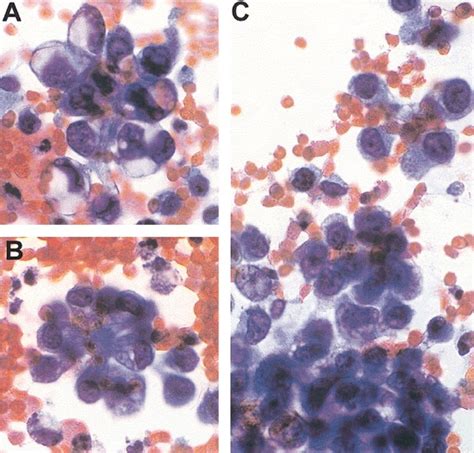 Urine Cytology Of Primary And Secondary Urinary Bladder Adenocarcinoma C1d