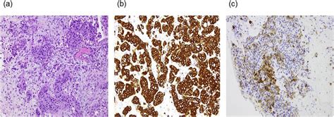 A Tumor Cells Have Large Hyperchromatic Nuclei And Eosinophilic