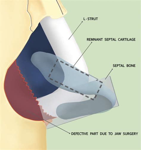 Schematic Image Of Septal Extension Graft Open I