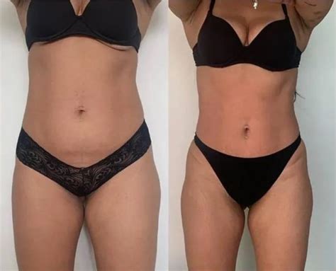 Hidrolipo Antes E Depois