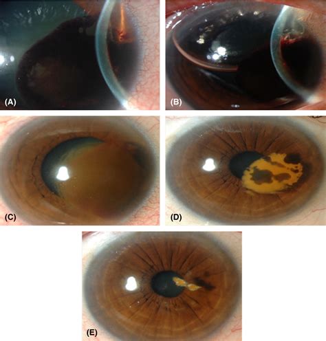 A Haemorrhagic Dmd After Canaloplasty In Patient With Primary Open