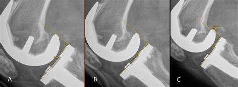 Anterior Tibial Translation A At Rest B Telos Stress And C Manual